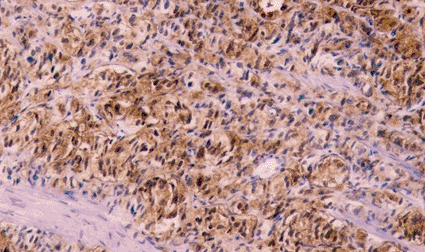 Image: Light micrograph of a section through a prostate gland showing cancerous cells (photo courtesy Dr. E. Walker / SPL). Image: Light micrograph of a section through a prostate gland showing cancerous cells (photo courtesy Dr. E. Walker / SPL).